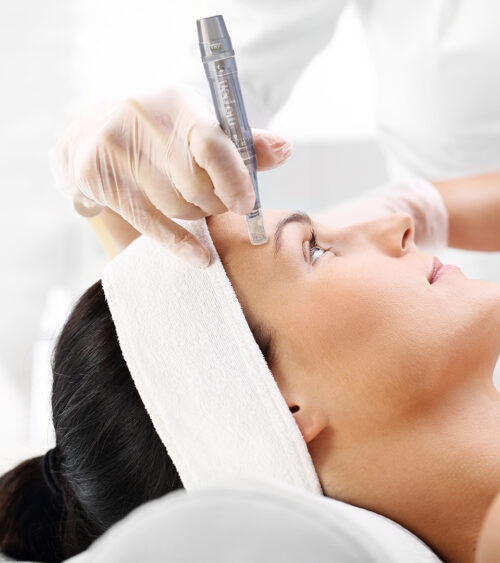 Ansigtsbehandling med Microneedling